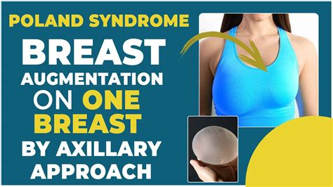 poland syndrome breast female